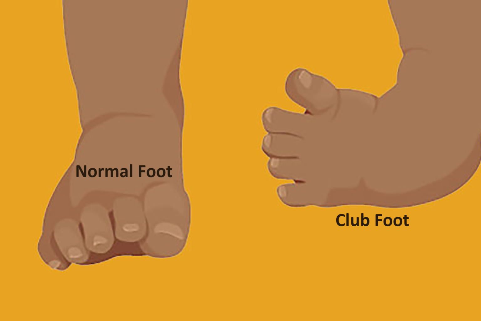 How to recognise if my baby's feet are normal or needs treatment? Clubfoot,  baby feet turning inward or outward